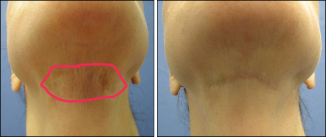 Scar Revision